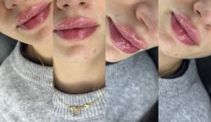 Zabieg modelowania ust